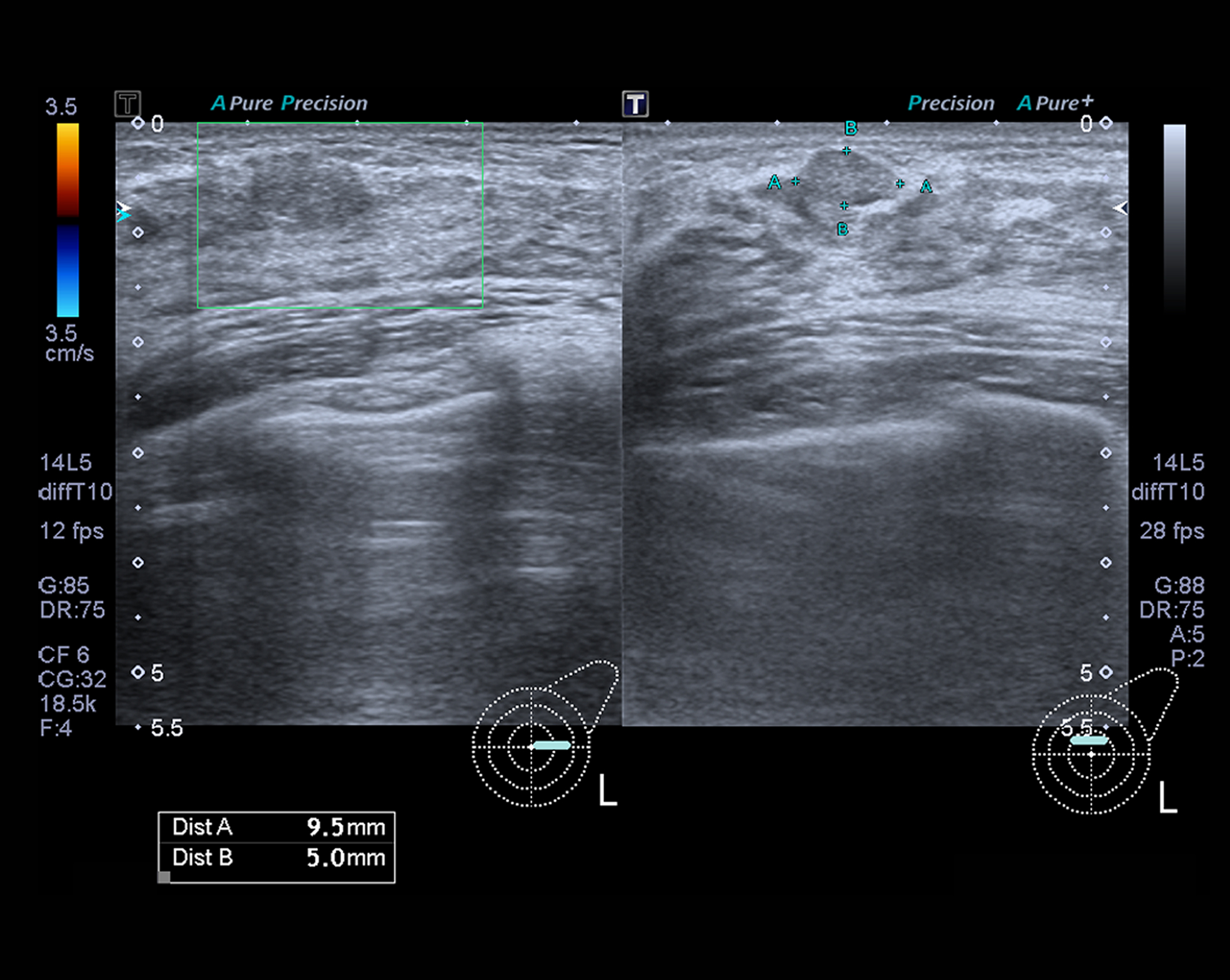 What Do They Measure In A Breast Ultrasound