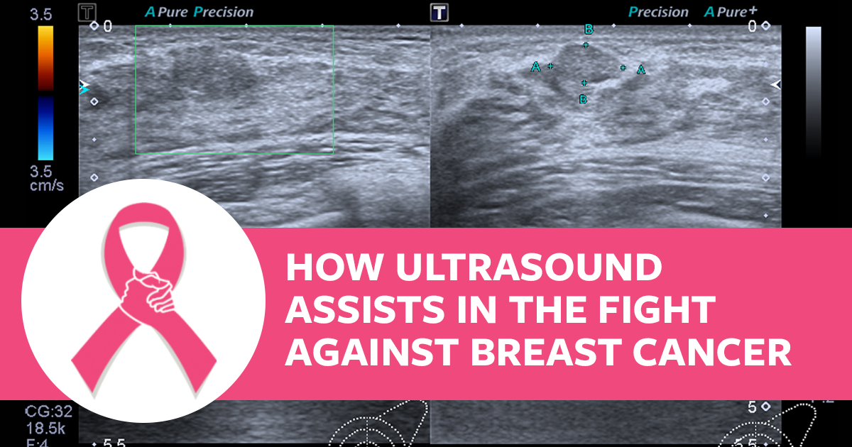 How Ultrasound Assists in the Fight Against Breast Cancer